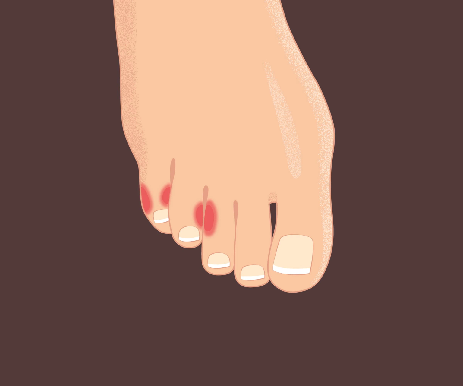 Слезает кожа между пальцами ног