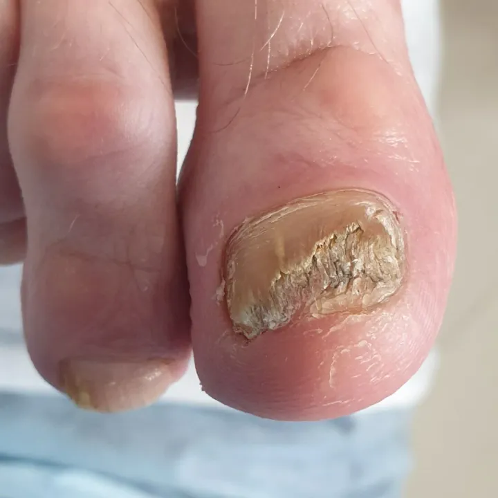 Грибок, который заразил 80% ногтя