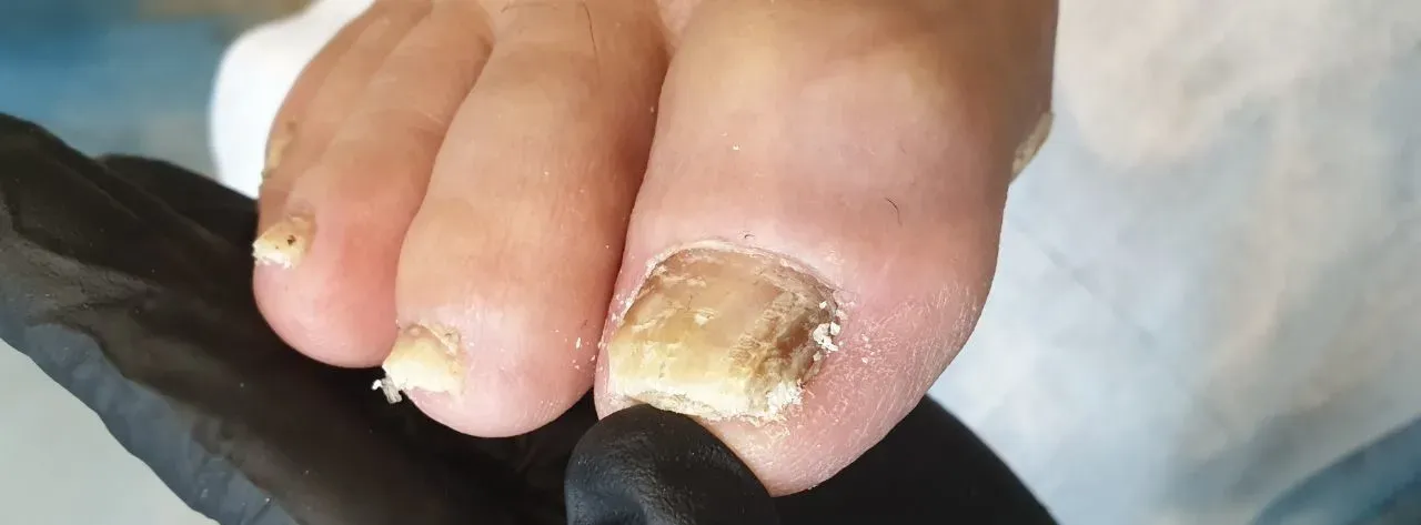 Пример грибка ногтей