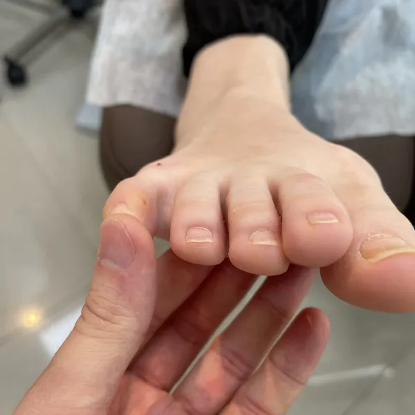 Малоинвазивное лечение контактных болезненных гиперкератозов пальцев стопы