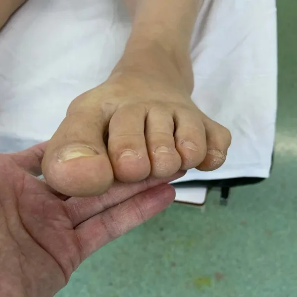 Боль в пальцах ног: причины, диагностика, лечение боли в суставах пальцев ног