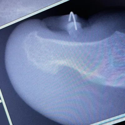 Рентген-фото экзостоза